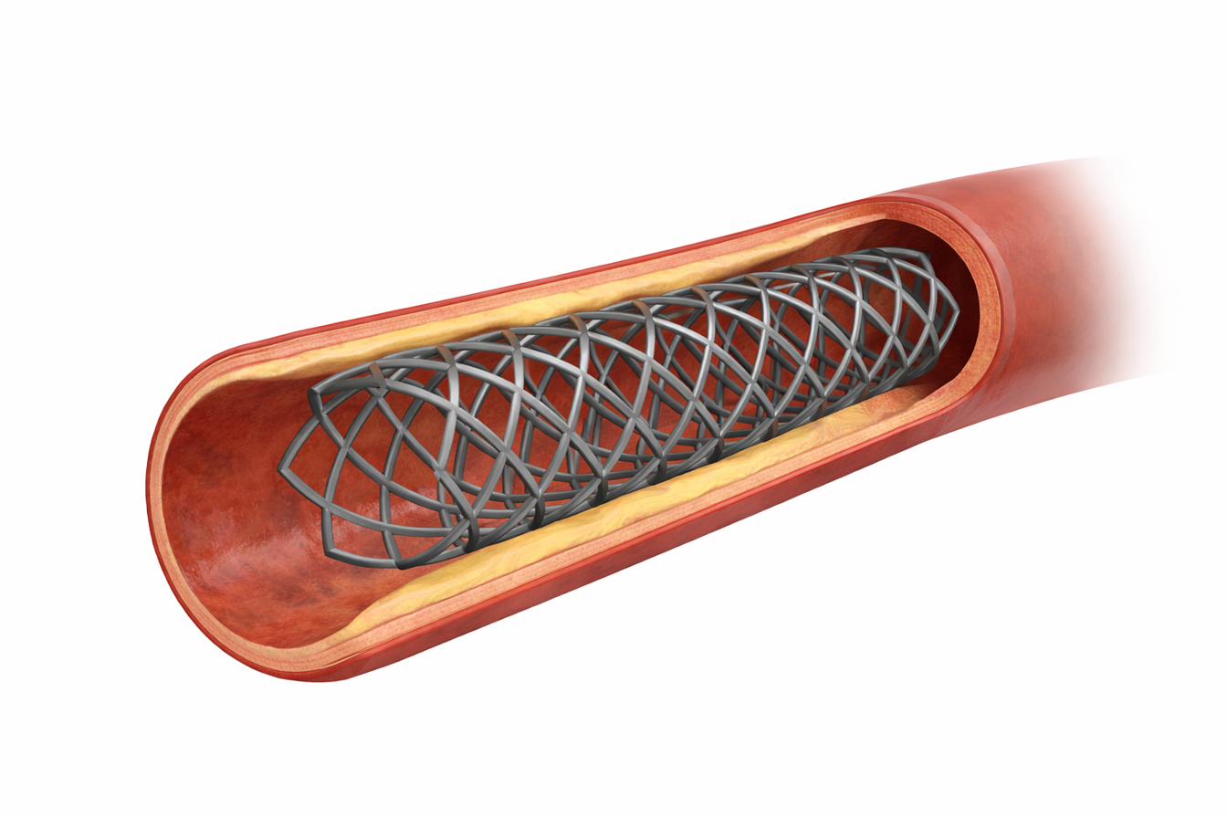 Bioabsorbable coronary stent inside artery cross-section